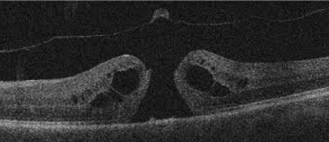 黄斑円孔OCT画像